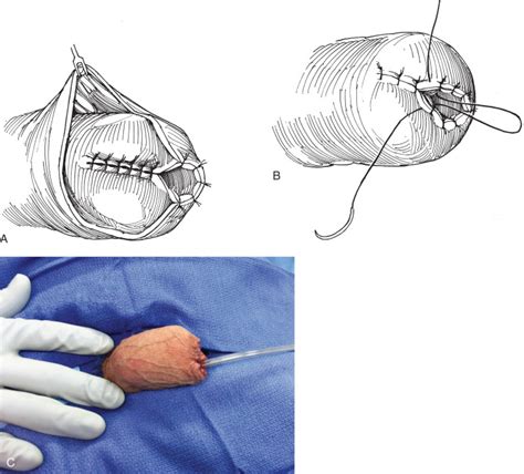 Pictures with tag(s): penectomy